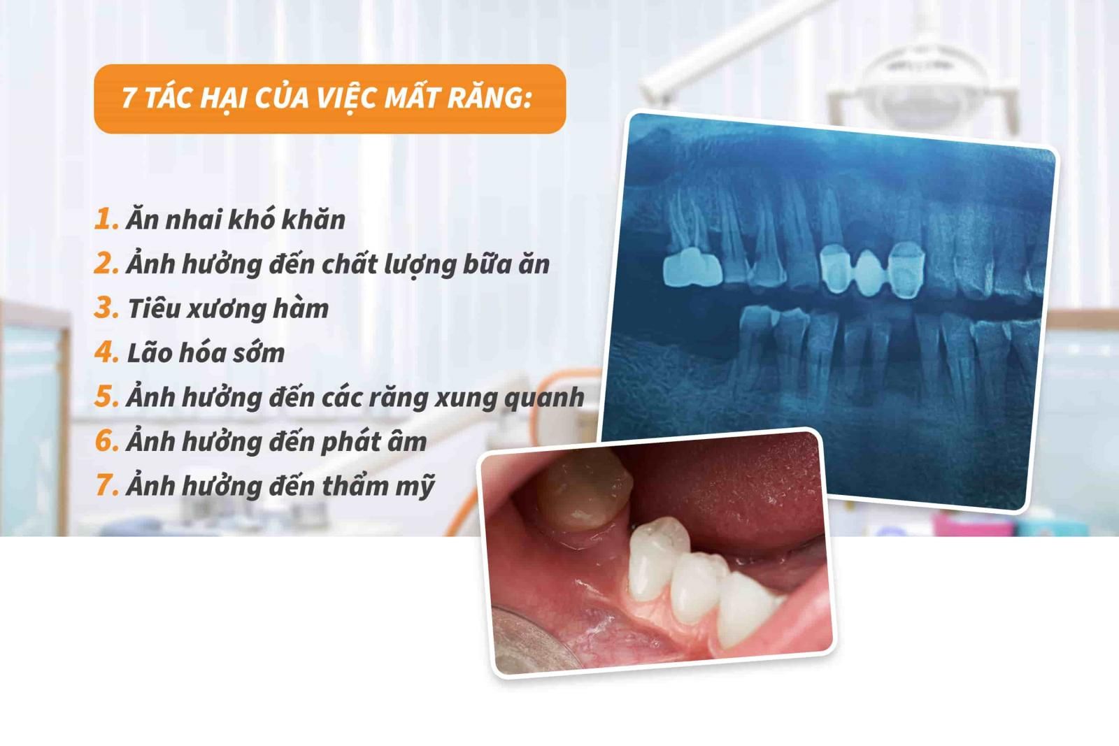 Mất răng và các tác hại